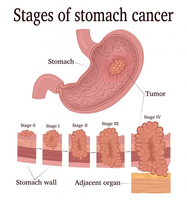  Cancer stage